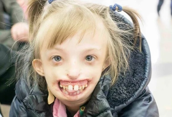 Operação permite que menina com mandíbula travada após infecção volte a  sorrir - 13/02/2014 - UOL Notícias