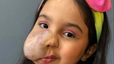 Menina branca em imagem de fundo cinza, com um laço colorido, cabelos castanhos e um hemangioma na bochecha direita