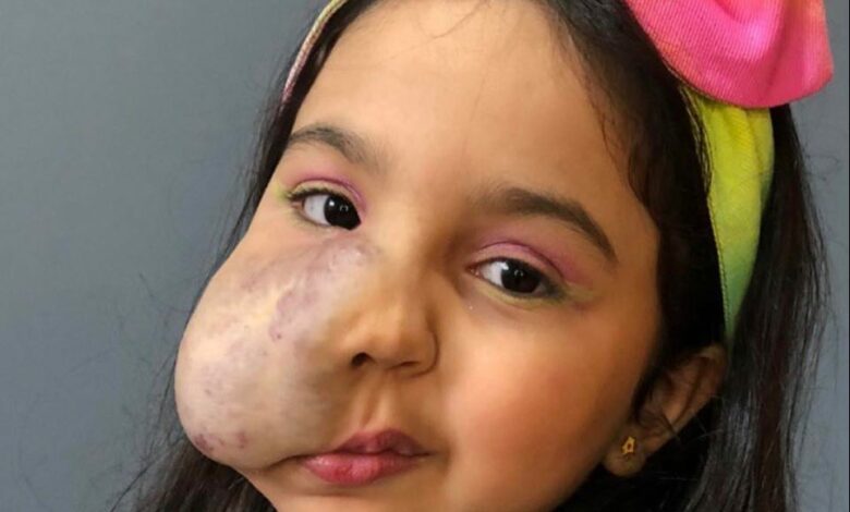 Menina branca em imagem de fundo cinza, com um laço colorido, cabelos castanhos e um hemangioma na bochecha direita